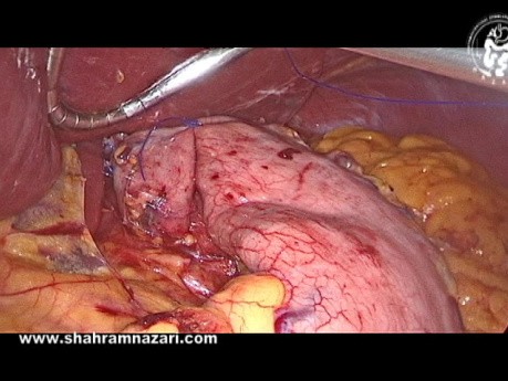 Loose Floppy Nissen Fundoplication
