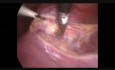 Blader Dissection