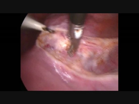 Blader Dissection