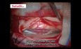 Application of TachoSil® Sealant Matrix in Durotomy Repair