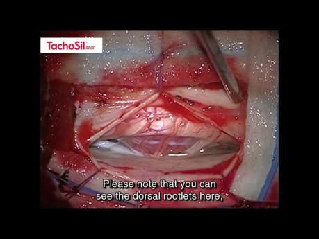 Application of TachoSil® Sealant Matrix in Durotomy Repair
