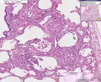 Sarcoidosis