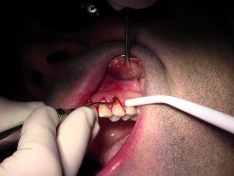 Tunneling Technique - Gingival Grafting #11-12