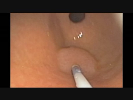 Endoscopic Islets Autotransplantation