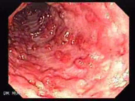 Colitis Ulcerosa - Pseudopolyps (4 of 22)