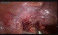 Laparoscopic Excision of Sigmoid Serocele 