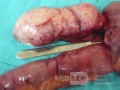 Appendiceal Carcinoid tumor (3 of 3)