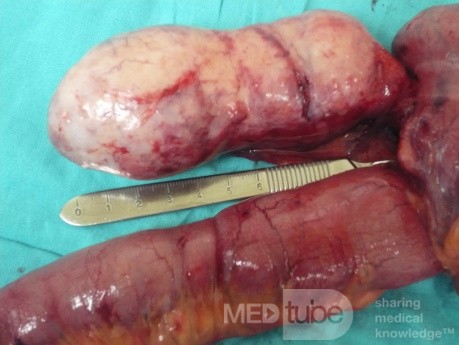 Appendiceal Carcinoid tumor (3 of 3)