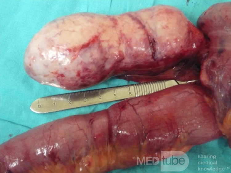 Appendiceal Carcinoid tumor (3 of 3)