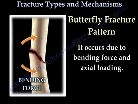 Working Bones Fractures, Types And Mechanisms 