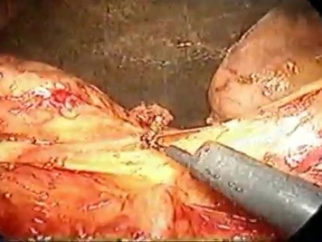 Pancreaticoduodenoctomy - part 1/3