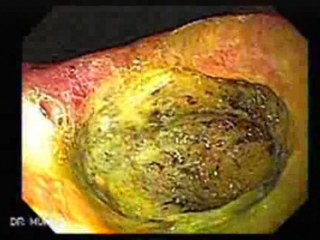 Klatskin´s Tumor - Presence of the Gastric Ulcer