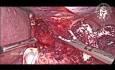 Methylene Blue Test after Myotomy Completion for Achalasia