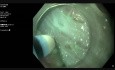 30 mm Lesion in the Upper Rectum, ESD