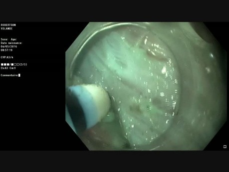 30 mm Lesion in the Upper Rectum, ESD