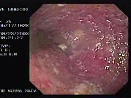 Esophageal Achalasia - Presence of the Food Leftovers