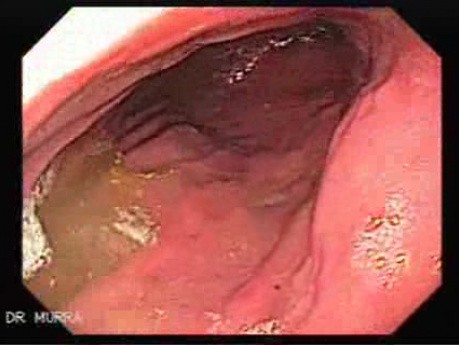 Adenocarcinoma of the Antrum (2 of 3)