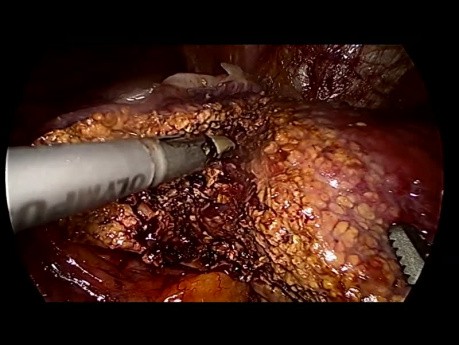 Left Lateral Liver Sectionectomy for Hcc in Segments 2/3