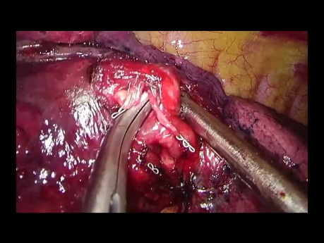 Uniportal VATS Right Anterobasal Anatomic Segmentectomy (S8)