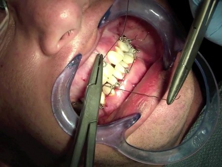 Jaw Fracture - Fixating Mandible And Maxilla