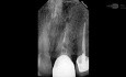 Endodontic Microsurgical Management of a Blocked Apex with Perforation