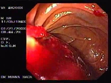 Carcinoma of the Papilla of Vater