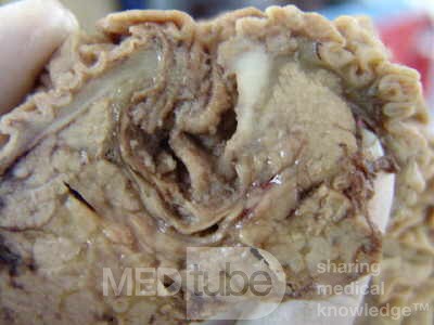 Cholangiocarcinoma that infiltrated a Periampullary Duodenal Diverticula and the head of the pancreas (11 of 20)