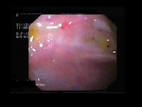 Endoscopic View Of Upper Gastrointestinal Hemorrhage- Forrest II