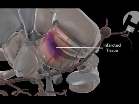 Incorrect Aneurysm Clipping