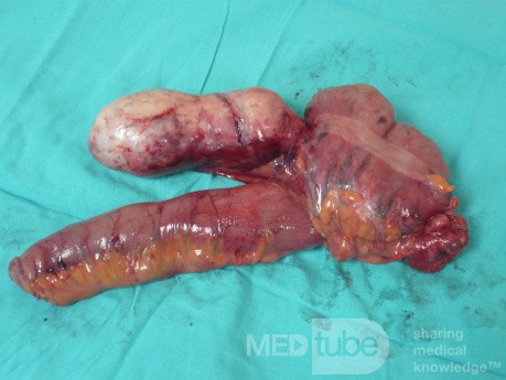 Appendiceal Carcinoid tumor (2 of 3)