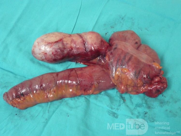 Appendiceal Carcinoid tumor (2 of 3)