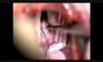 Decompression of Hemifacial Spasm, Right Side, Through a Retrosigmoid Approach