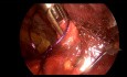 Peritoneal Breach Repair During TEP Surgery