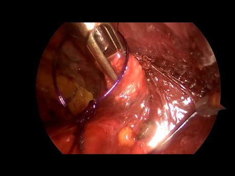 Peritoneal Breach Repair During TEP Surgery