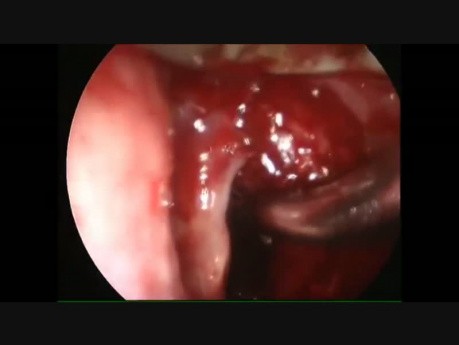 Endoscopic Transglottic Carcinoma Excision