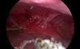 Laparscopic Excision of Hydatid Cyst