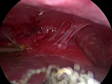 Laparscopic Excision of Hydatid Cyst