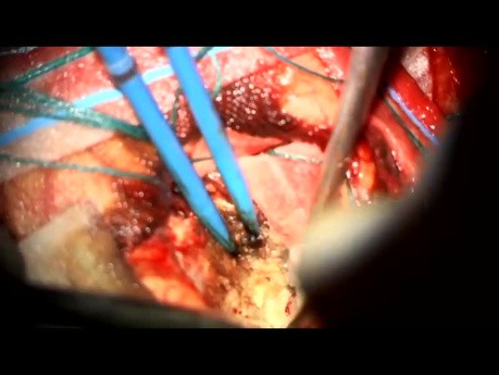 Left Occipital Craniotomy and Resection of Large Parafalcine Meningioma