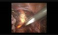 Laparoscopyic Hysterectomy with Lighted Uterine Manipulator