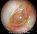 Middle Ear Elevation with Air Bubble