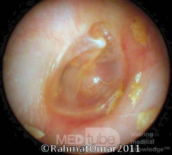Middle Ear Elevation with Air Bubble