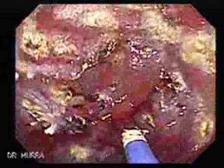 Post-Radiation Colitis (6 of 13)