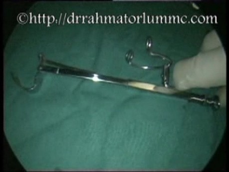 Uvulopalatal Retraction Device for Exposure of Nasopharynx