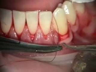 Biomaterials - Best Way To Cover Gingival Recession