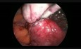 Laparoscopic Large Posterior Myomectomy