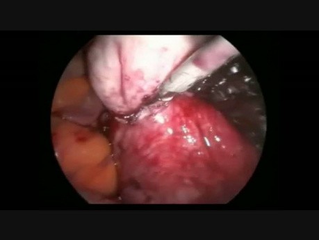 Laparoscopic Large Posterior Myomectomy