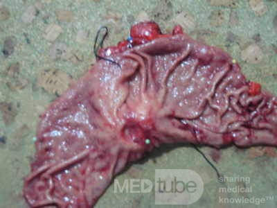 Diffuse Adenocarcinoma with signet ring cells (13 of 18)