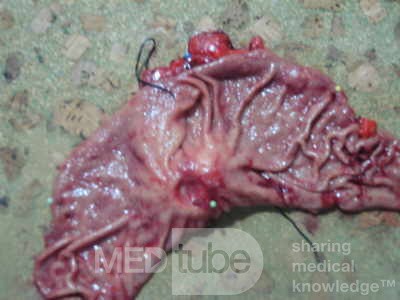 Diffuse Adenocarcinoma with signet ring cells (13 of 18)