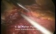 Total gastrectomy with D2 Resection - Laparoscopic Approach