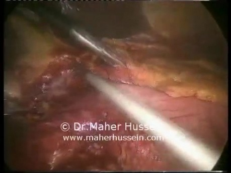 Total gastrectomy with D2 Resection - Laparoscopic Approach